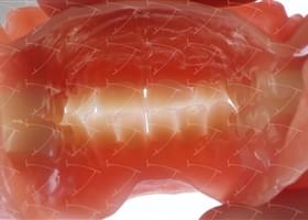Total Prothesis in Acrylic  Resin with Teeth made of ... con denti del commercio in resina acrilica abbottonata su impianti