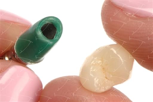 Bridges and Crowns in Cobalt Chrome and Ceramics cemented  on the Integral Castable  Abutments