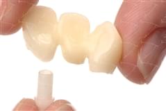 Bridges and Crowns in Zirconium and Ceramics cemented on the Integral Castable Abutments