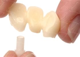 Bridges and Crowns in Zirconium and Ceramics cemented on the Integral Castable Abutments