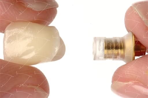 Bridges and Crowns in Zirconium and Ceramics cemented  on the Metal-based Castable Abutments