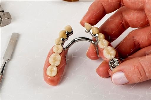 Skeleton for Combination with Crowns in Cobalt Chrome and Ceramics with Lingual Bar