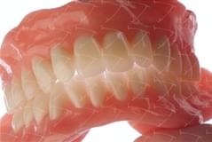 Total Prothesis in Acrylic  Resin with Teeth made of …  con denti del commercio in ceramica abbottonata su impianti
