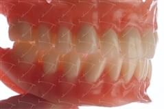 Total Prothesis in Acrylic  Resin with Teeth made of … con denti del commercio in ceramica abbottonata su impianti