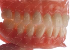 Total Prothesis in Acrylic  Resin with Teeth made of … con denti del commercio in ceramica abbottonata su impianti