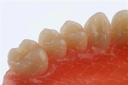 Total Prothesis in Acrylic  Resin with Teeth made of …  con denti del commercio in ceramica