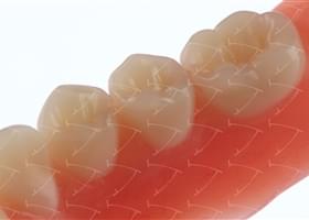 Total Prothesis in Acrylic  Resin with Teeth made of ...  con denti del commercio in ceramica