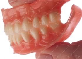 Total Prothesis in Acrylic  Resin with Teeth made of … con denti del commercio in composito abbottonata su denti naturali