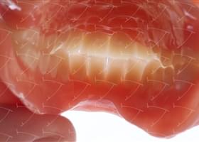 Total Prothesis in Acrylic  Resin with Teeth made of … con denti del commercio in composito abbottonata su denti naturali