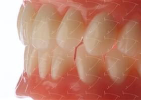 Total Prothesis in Acrylic  Resin with Teeth made of …  con denti del commercio in composito abbottonata su denti naturali
