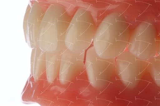 Total Prothesis in Acrylic  Resin with Teeth made of …  con denti del commercio in composito abbottonata su denti naturali