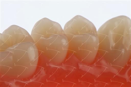 Total Prothesis in Acrylic  Resin with Teeth made of ... con denti del commercio in composito abbottonata su denti naturali