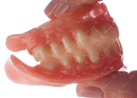 Total Prothesis in Acrylic  Resin with Teeth made of …  con denti del commercio in composito abbottonata su impianti