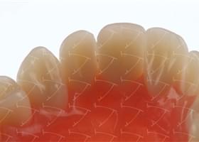 Total Prothesis in Acrylic  Resin with Teeth made of … con denti del commercio in composito abbottonata su impianti