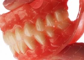Total Prothesis in Acrylic  Resin with Teeth made of … con denti del commercio in composito abbottonata su impianti