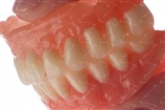 Total Prothesis in Acrylic  Resin with Teeth made of ... con denti del commercio in composito abbottonata su impianti