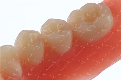 Total Prothesis in Acrylic  Resin with Teeth made of ... con denti del commercio in resina acrilica  abbottonata su denti naturali