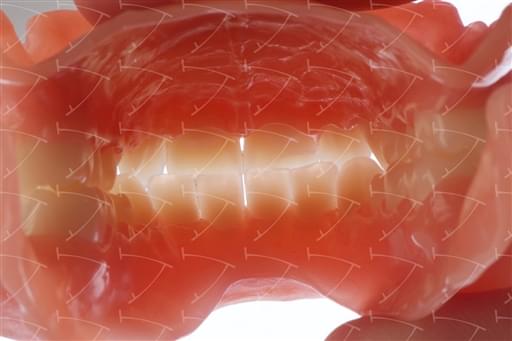 Total Prothesis in Acrylic  Resin with Teeth made of ... con denti del commercio in resina acrilica abbottonata su impianti