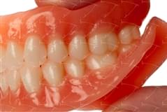 Total Prothesis in Acrylic  Resin with Teeth made of … con denti del commercio in resina acrilica abbottonata su impianti