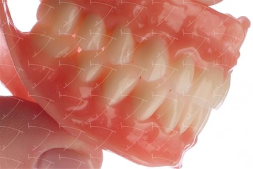 Protesi totale in resina acrilica con denti del commercio in ceramica abbottonata su denti naturali