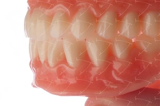 Protesi totale in resina acrilica con denti del commercio in ceramica abbottonata su denti naturali