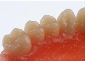 Protesi totale in resina acrilica con denti del commercio in ceramica