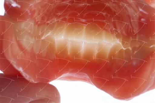 Protesi totale in resina acrilica con denti del commercio in composito abbottonata su denti naturali