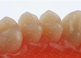 Protesi totale in resina acrilica con denti del commercio in composito abbottonata su denti naturali
