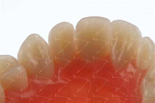 Protesi totale in resina acrilica con denti del commercio in composito abbottonata su impianti