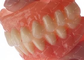 Protesi totale in resina acrilica con denti del commercio in composito abbottonata su impianti
