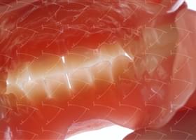 Protesi totale in resina acrilica con denti del commercio in resina acrilica  abbottonata su denti naturali