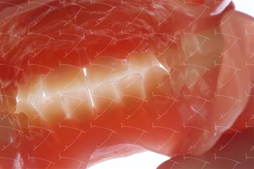 Protesi totale in resina acrilica con denti del commercio in resina acrilica  abbottonata su denti naturali