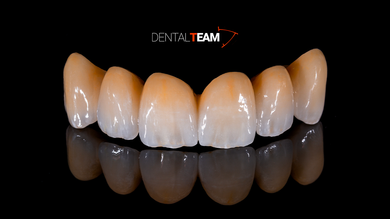 Corone zirconio-ceramica
