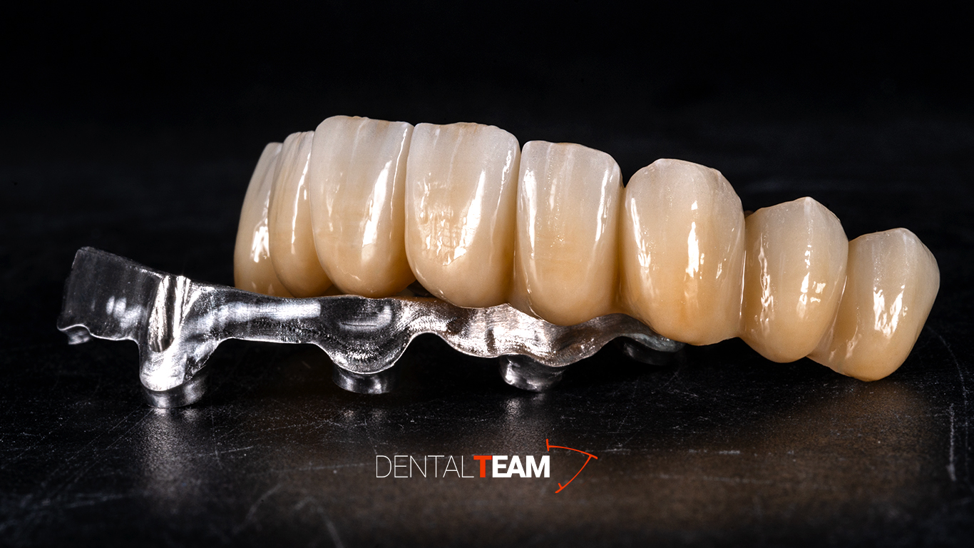 Toronto in zirconio-ceramica con sottostruttura in metallo