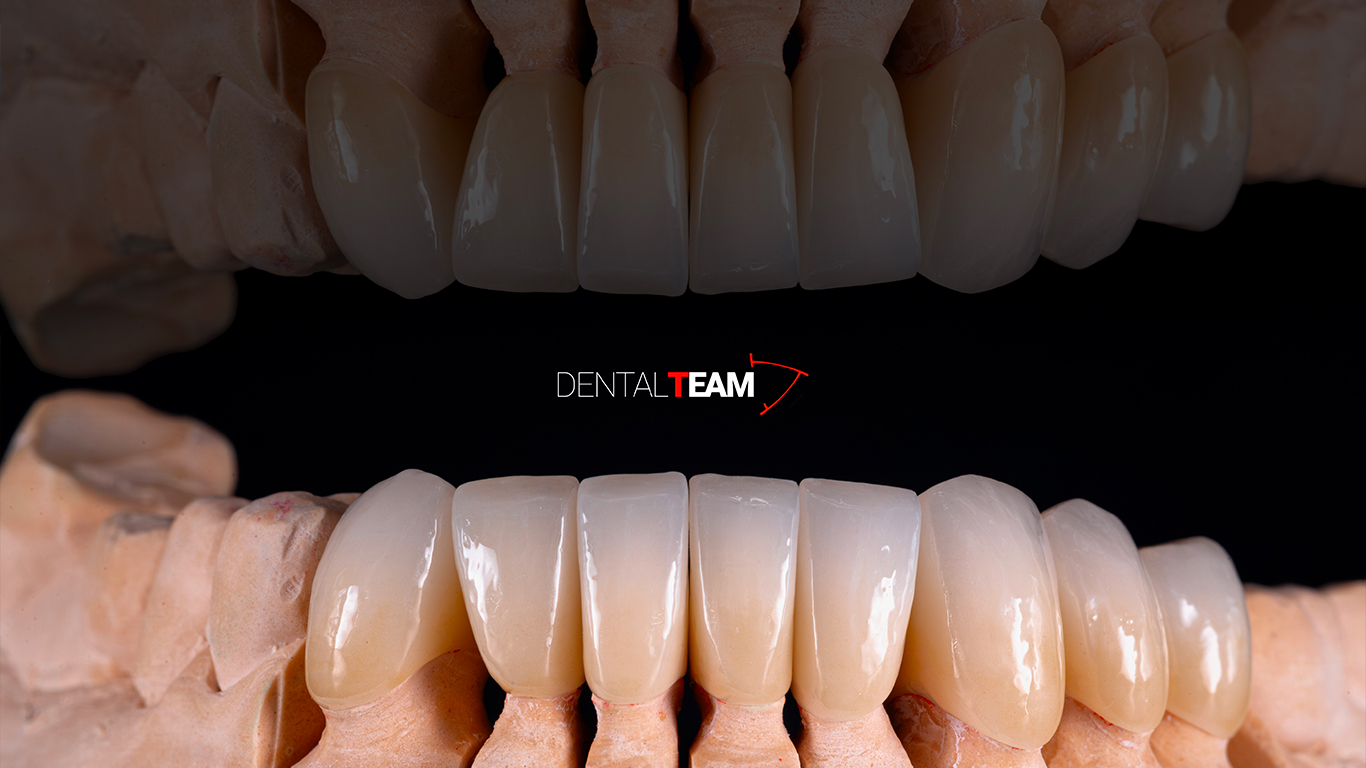 Corone zirconia monolitica