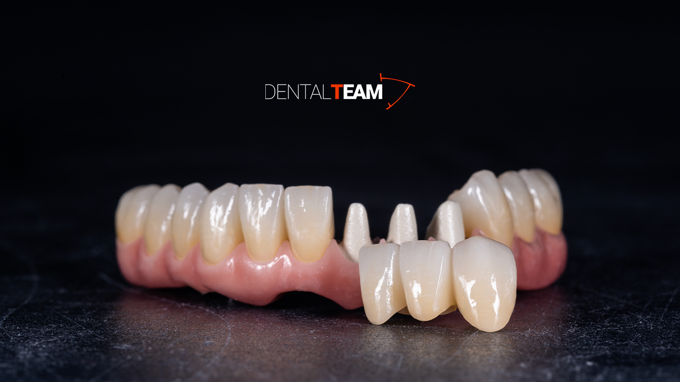 Toronto in metallo con thimble e zirconie monolitiche incollate